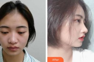 鎮(zhèn)江華儷醫(yī)療美容門診部王擊進(jìn)整形價(jià)格表附肋軟骨隆鼻案例展示