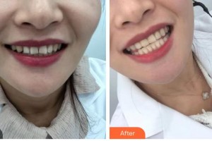 鎮(zhèn)江市口腔醫(yī)院韋愛君整形價(jià)格表附牙貼面案例展示