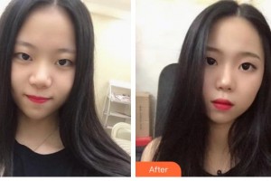 湘潭市中心醫(yī)院醫(yī)學(xué)整形美容科陳婷婷整形價(jià)格表附鼻部綜合案例展示