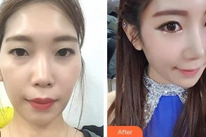 湘潭市中心醫(yī)院醫(yī)學(xué)整形美容科李志剛整形價(jià)格表附鼻部綜合案例展示