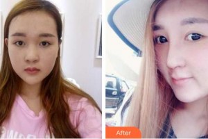 湘潭華美整形醫(yī)院張勝昌整形價格表附鼻部綜合案例展示