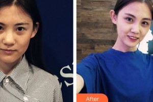 湘潭華美整形醫(yī)院劉攀整形價(jià)格表附鼻部綜合案例展示