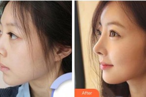 湘潭顧維新醫(yī)療美容診所顧維新整形價(jià)格表附假體隆鼻案例展示