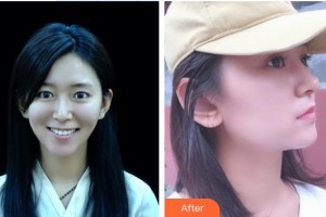 湘潭愛(ài)爾眼科醫(yī)院羅葉軍整形價(jià)格表附切開(kāi)雙眼皮案例展示