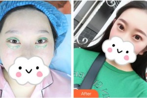 湘潭陽(yáng)光門診部譚兵整形價(jià)格表附眼部綜合案例展示