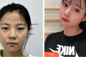 湘潭愛(ài)爾眼科醫(yī)院王瑞平整形價(jià)格表附切開(kāi)雙眼皮案例展示