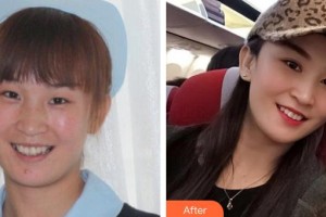 湘潭愛(ài)爾眼科醫(yī)院劉祥明整形價(jià)格表附眼部綜合案例展示