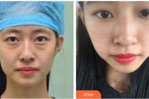 湘潭愛(ài)爾眼科醫(yī)院李仁華整形價(jià)格表附內(nèi)切祛眼袋案例展示