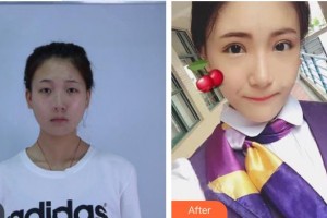 湘潭愛(ài)爾眼科醫(yī)院毛安真整形價(jià)格表附眼部整形案例展示