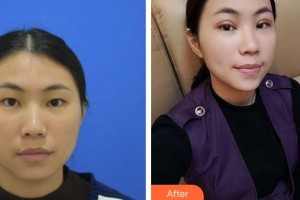 湘潭愛(ài)爾眼科醫(yī)院羅皓平整形價(jià)格表附定點(diǎn)雙眼皮案例展示