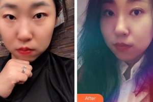 永州新唯美整形美容醫(yī)院安棟顯整形價(jià)格表附眼部修復(fù)案例展示