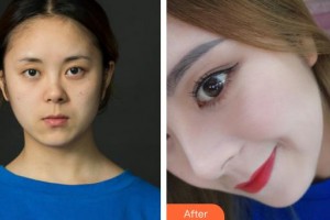 永州新唯美整形美容醫(yī)院薛澈煥整形價(jià)格表附鼻部綜合案例展示