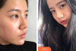 永州博美整形美容醫(yī)院劉躍珠整形價(jià)格表附鼻修復(fù)案例展示