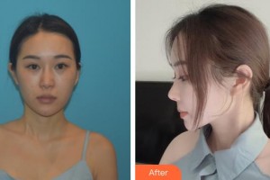 永州博美整形美容醫(yī)院陳璋整形價(jià)格表附肋軟骨隆鼻案例展示