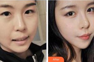 永州佳美醫(yī)學(xué)整形美容醫(yī)院黃南儒整形價(jià)格表附假體隆鼻案例展示