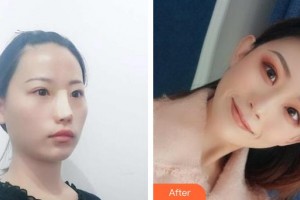 永州博美整形美容醫(yī)院陳建華住院醫(yī)師整形價(jià)格表附鼻部綜合案例展示