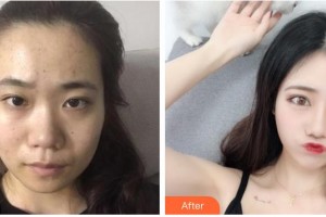 永州星雅醫(yī)療美容門(mén)診部張光輝整形價(jià)格表附鼻部綜合案例展示