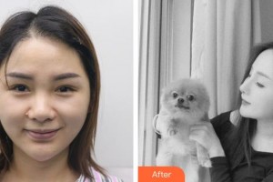 永州新唯美整形美容醫(yī)院陳文可整形價(jià)格表附肋軟骨隆鼻案例展示