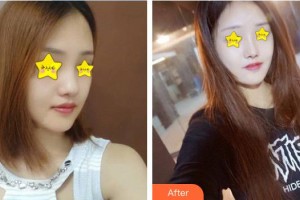 永州新唯美整形美容醫(yī)院王勇整形價(jià)格表附鼻部綜合案例展示