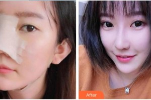 永州新唯美整形美容醫(yī)院劉尚海整形價(jià)格表附鼻部綜合案例展示