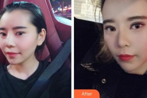 永州市皮膚病醫(yī)院醫(yī)療美容科伍美云整形價(jià)格表附鼻部綜合案例展示