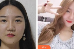 永州傾城醫(yī)療美容門(mén)診部嚴(yán)興萍整形價(jià)格表附假體隆鼻案例展示