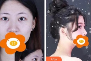 永州傾城醫(yī)療美容門(mén)診部楊維整形價(jià)格表附鼻部綜合案例展示