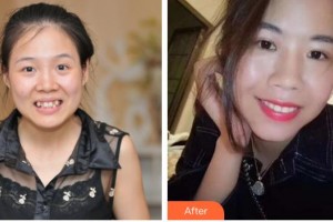 永州中南口腔醫(yī)院余芳英整形價(jià)格表附自鎖托槽矯正案例展示