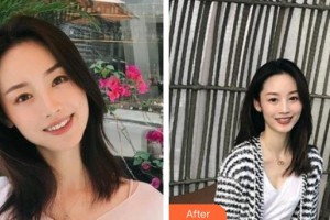 永州中南口腔醫(yī)院邵碩整形價(jià)格表附金屬托槽矯正案例展示