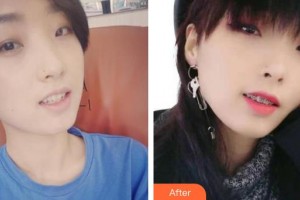 永州國(guó)斌口腔門(mén)診部劉阿寶整形價(jià)格表附金屬托槽矯正案例展示