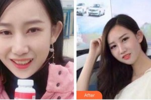 永州國斌口腔門診部唐穎文整形價(jià)格表附牙齒隱形矯正案例展示