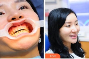 永州牙博士口腔醫(yī)院陳東波整形價(jià)格表附美白貼片案例展示