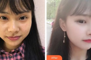 永州愛爾眼科醫(yī)院唐勛倫整形價(jià)格表附埋線雙眼皮案例展示