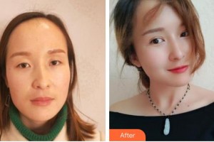 永州愛爾眼科醫(yī)院李格明整形價(jià)格表附眼部綜合案例展示