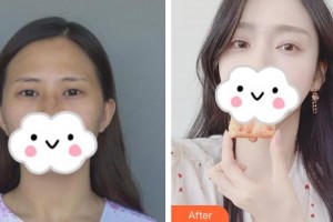 永州愛爾眼科醫(yī)院張艷整形價(jià)格表附眼部綜合案例展示