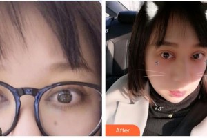 永州愛爾眼科醫(yī)院胡艷玲整形價(jià)格表附外切祛眼袋案例展示