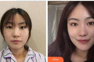 永州市第一人民醫(yī)院眼科趙永旺整形價(jià)格表附切開雙眼皮案例展示