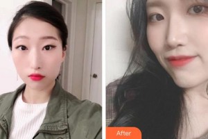 永州愛爾眼科醫(yī)院陳艷文整形價(jià)格表附眼部綜合案例展示