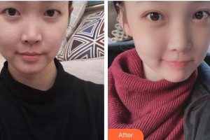 順德中西醫(yī)結(jié)合醫(yī)院整形激光美容醫(yī)療中心譚春明整形價(jià)格表附切開雙眼皮案例展示