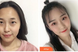 順德愛爾眼科醫(yī)院劉巧萍整形價(jià)格表附眼部綜合案例展示