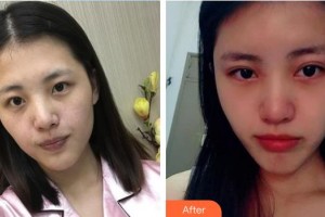 順德愛爾眼科醫(yī)院霍敏灼整形價(jià)格表附埋線雙眼皮案例展示