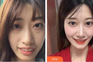 順德愛爾眼科醫(yī)院趙偉整形價(jià)格表附眼部綜合案例展示