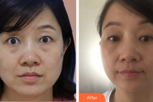 順德愛爾眼科醫(yī)院趙亞軍整形價(jià)格表附切開雙眼皮案例展示