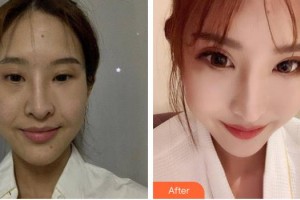 漢中市中心醫(yī)院燒傷整形美容外科李金友整形價格表附埋線提升案例展示