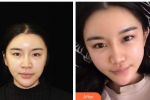 漢中韓美整形美容醫(yī)院常雙模整形價格表附埋線提升案例展示