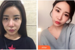 漢中南方醫(yī)療美容診所李雪整形價格表附埋線提升案例展示