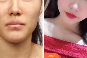 漢中韓美整形美容醫(yī)院李峻福整形價格表附埋線提升案例展示