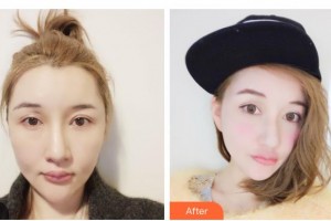 漢中華美奧萊醫(yī)學(xué)整形美容醫(yī)院郭增整形價格表附超聲提拉案例展示