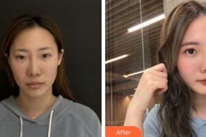 漢中天漢伊美醫(yī)療美容門診部張茜整形價格表附熱瑪吉案例展示