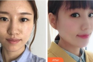 漢中天漢伊美醫(yī)療美容門診部劉思學(xué)整形價格表附埋線提升案例展示